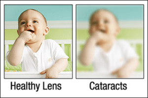Cataracts Vision Comparison 