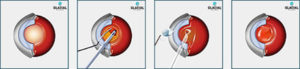 Cataract Surgery Diagram